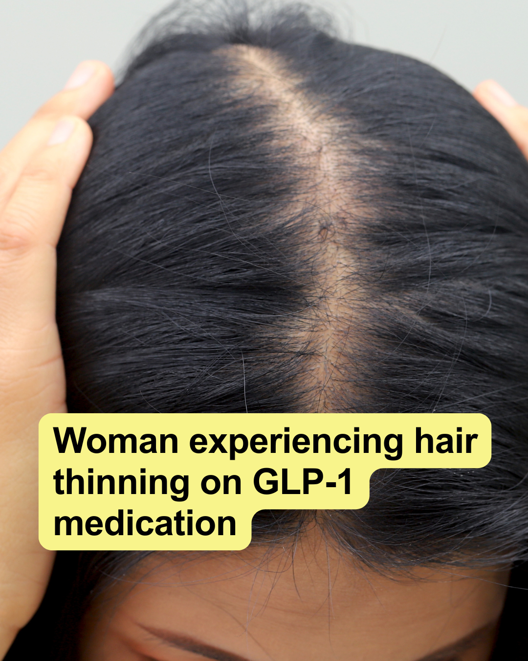 Losing Hair on Ozempic? Here's What's Actually Happening - and How to Get It Back