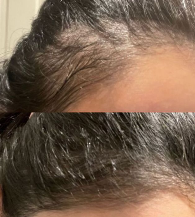 6 Month Hair Growth Bundle