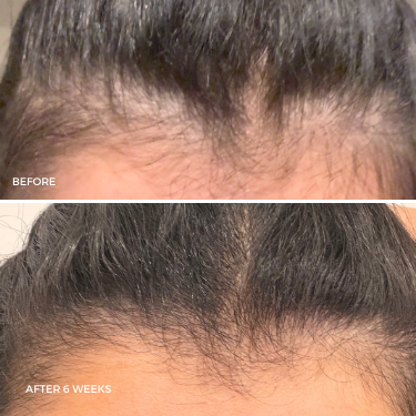 The Magic Hair Growth Serum with Micro-infusion Applicator