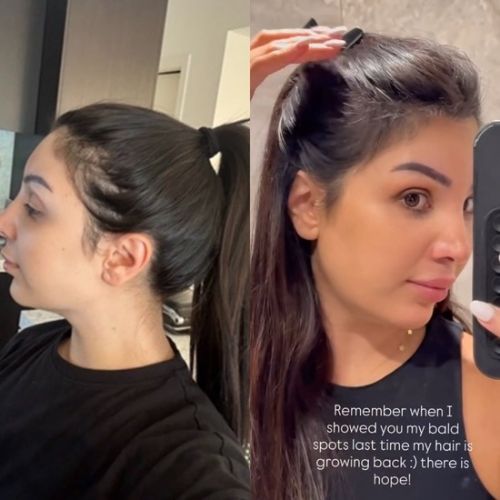 6 Month Hair Growth Bundle