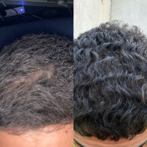 6 Month Hair Growth Bundle